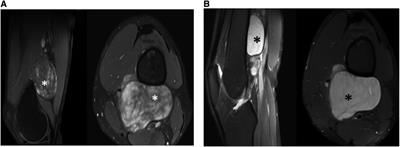 Left distal sciatic giant solitary myxoid neurofibroma: a case report & literature review